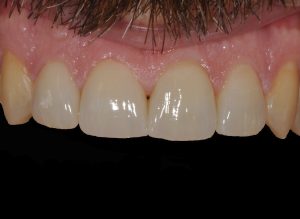 Faccette dentali a Cefalù