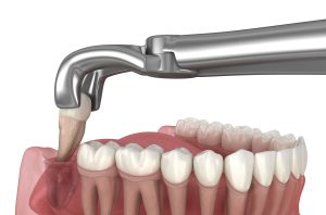 dente del giudizio