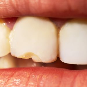 Dente scheggiato o rotto