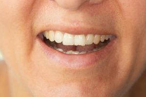 Dente scheggiato o rotto